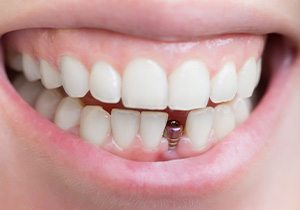 Woman smiling with a dental implant