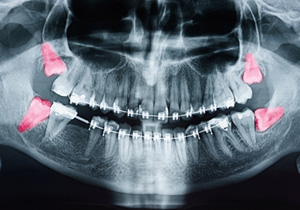 A dental X-ray of multiple impacted wisdom teeth