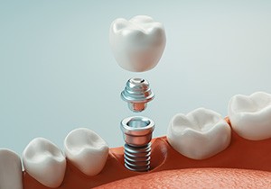 A 3D rendering of the parts of a dental implant
