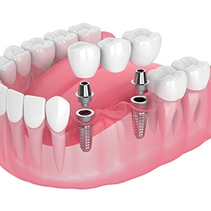 a close-up of a model of dental implants