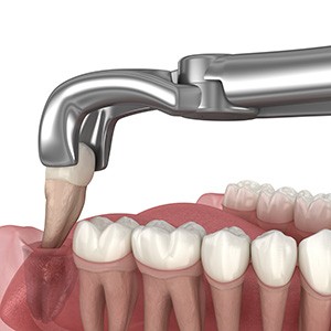 Illustration of a tooth being extracted