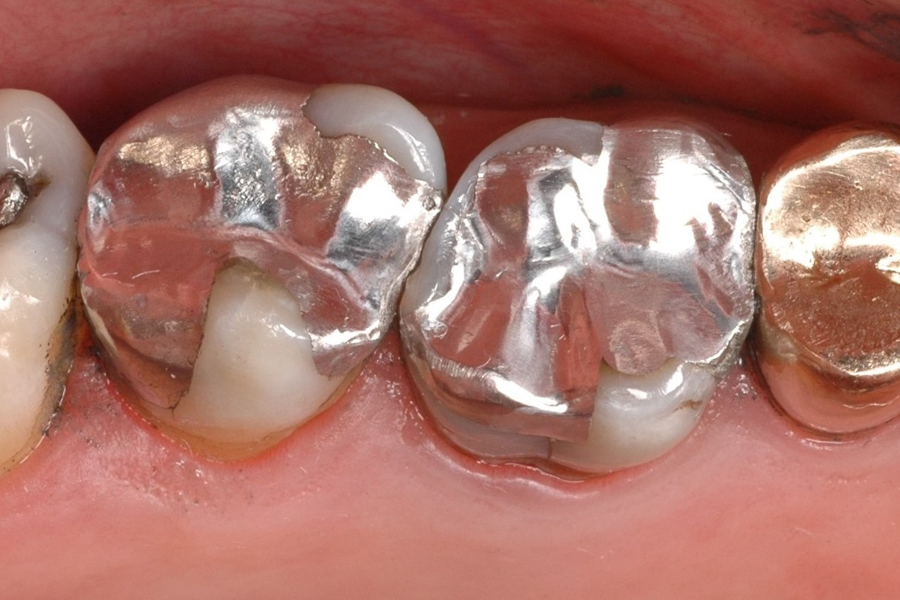 Ada stance deals on amalgam